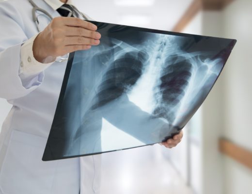 Tumore al polmone: la prevenzione personalizzata